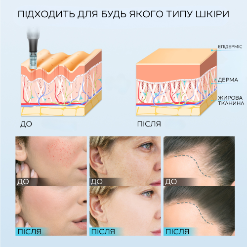 Беспроводной Електрический Дермапен Dr. Pen M7s Дермаштамп на Аккумуляторе Для Фракционной Мезотерапии Лица и Тела Серебро Dr.Pen